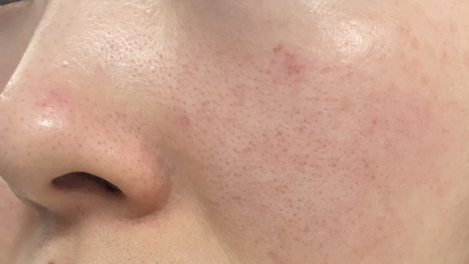 酒さ（しゅさ）・赤ら顔｜頬の赤み・ほてり・ニキビ様発疹を腸・LPS・亜鉛・オメガ3から整える分子栄養学